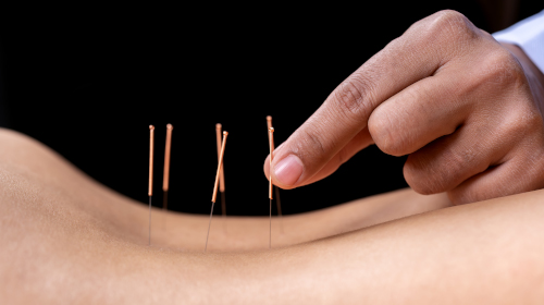 A mão de um homem coloca agulhas de acupuntura nas costas de cliente.
